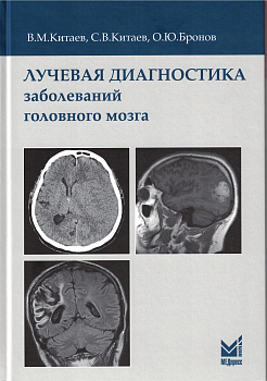 Лучевая диагностика заболеваний головного мозга