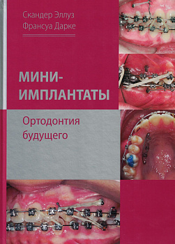 Мини-имплантаты. Ортодонтия будущего.