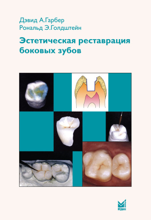 350_Jesteticheskaja_restavracija_bokovyh_zubovwGarberz.jpg
