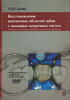 Восстановление контактных областей зубов с помощью матричных систем