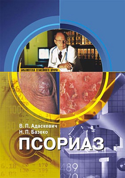 Псориаз