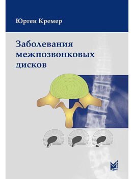 Заболевания межпозвонковых дисков