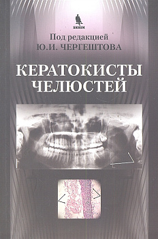 Кератокисты челюстей