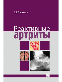 Реактивные артриты 