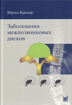 Заболевания межпозвонковых дисков